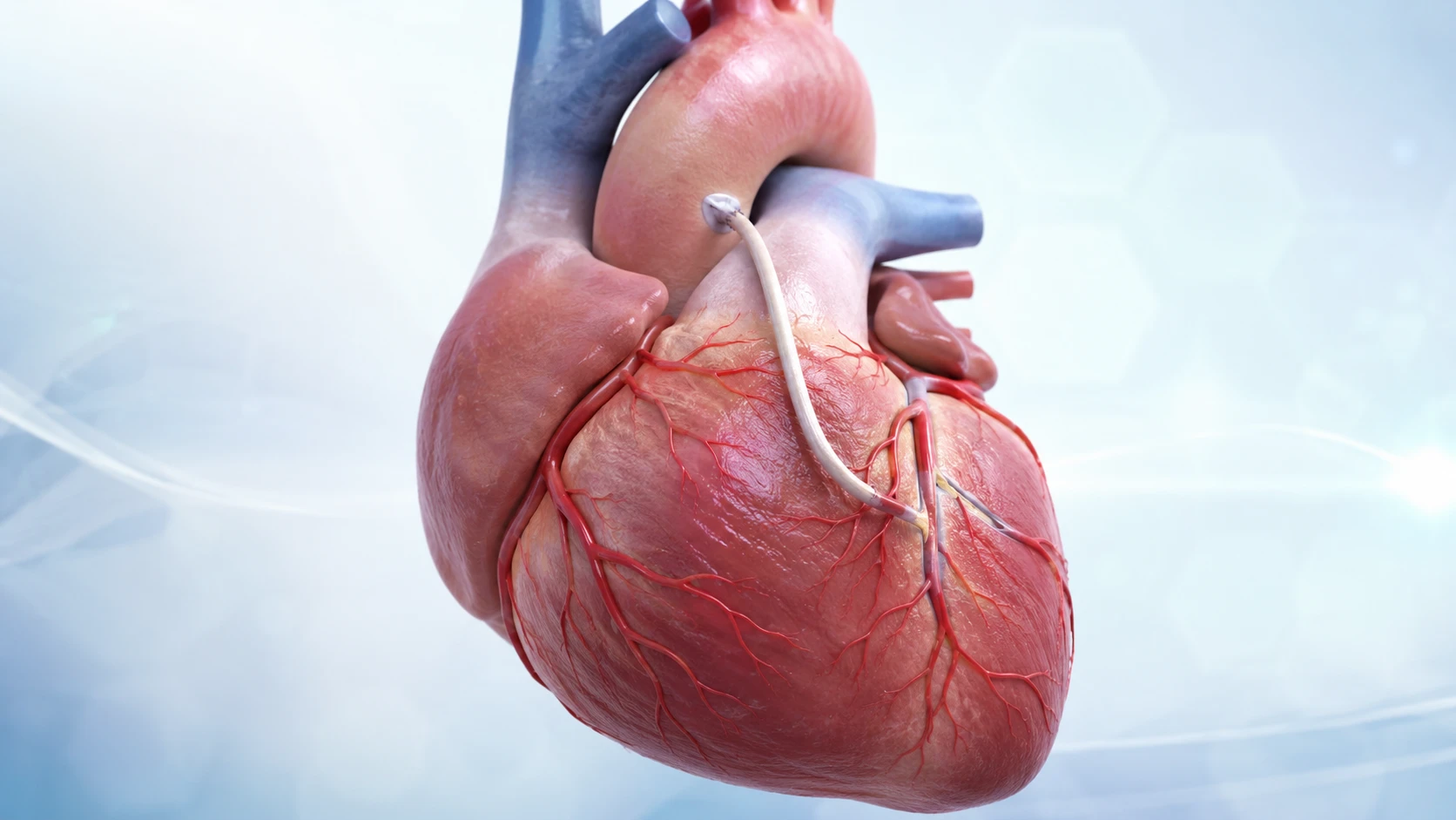 CABG Surgery Explained: When Is Heart Bypass Surgery Needed?